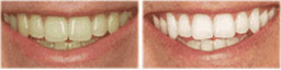 before and after